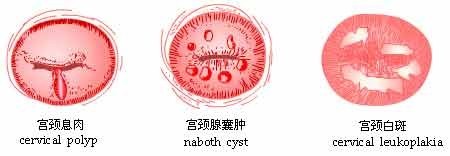 孕期宫颈息肉该怎么治疗？